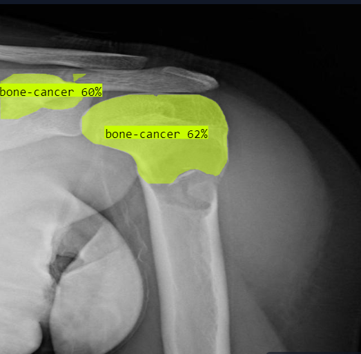 Bone Tumor Prediction